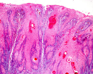 Oral cancer. Squamous cell carcinoma