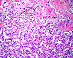 Human ovary. Papillary carcinoma
