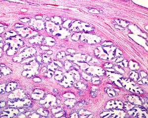 Human prostate hyperplasia