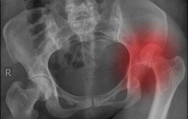 hip dislocation , x ray image 
