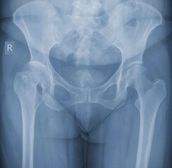 hip dislocation , x ray image 

