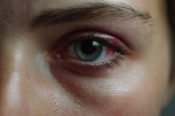 An accidentally bruised eye area, showing the delicate nature of facial injuries and care needs.