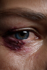 An accidentally bruised eye area, showing the delicate nature of facial injuries and care needs.