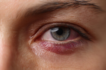 Fototapeta premium An accidentally bruised eye area, showing the delicate nature of facial injuries and care needs.