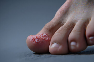 Macro shot of a blister on a foot due to friction from walking, highlighting the skin texture.