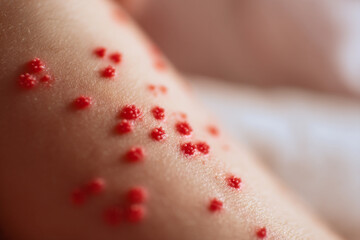 Fototapeta premium Close-up of chickenpox blisters on skin, highlighting contagious childhood diseases and care.