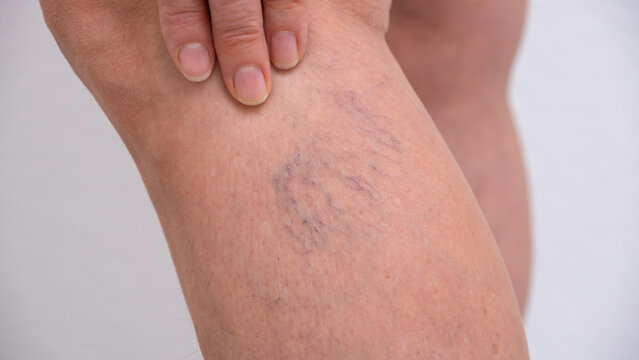 Varicose veins on women's legs. Close-ups of spider veins, dilated capillaries on a woman's shin that can be removed by sclerotherapy, reticular veins. Stage one. Phlebology.