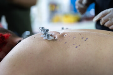 wenflon wbity w plecy na pokazie piercingu