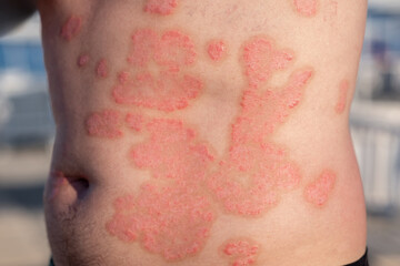 Fototapeta premium Psoriasis Visible on the Torso of an Individual During an Outdoor Activity in a Sunny Environment
