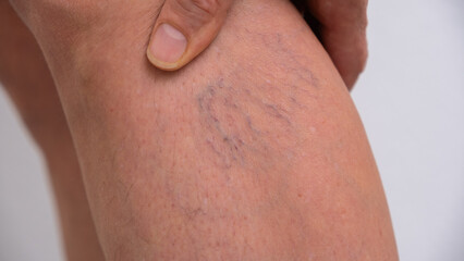 Varicose veins on women's legs. Close-ups of spider veins, dilated capillaries on a woman's shin that can be removed by sclerotherapy, reticular veins. Stage one. Phlebology. © leesle