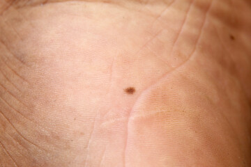 Fototapeta premium human foot sole with small dark mole on the skin surface, skin texture details are clearly visible, skin health concept and natural pigmentation signs. nevus