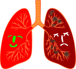 Vector illustration, Comparison of Healthy Lungs and Sick Lungs