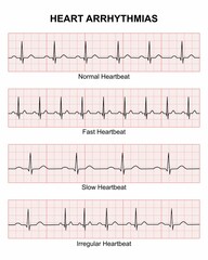 Heart Arrhythmias Heartbeat Illustration