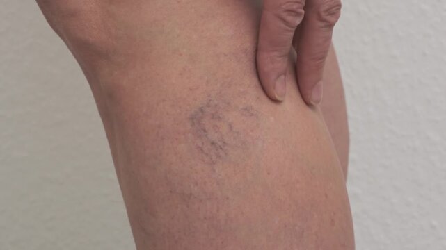 Varicose veins on women's legs. Close-ups of spider veins, dilated capillaries on a woman's shin that can be removed by sclerotherapy, reticular veins. Stage one. Phlebology.