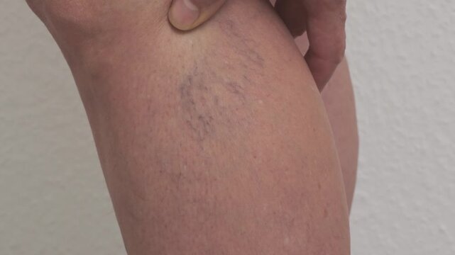 Varicose veins on women's legs. Close-ups of spider veins, dilated capillaries on a woman's shin that can be removed by sclerotherapy, reticular veins. Stage one. Phlebology.