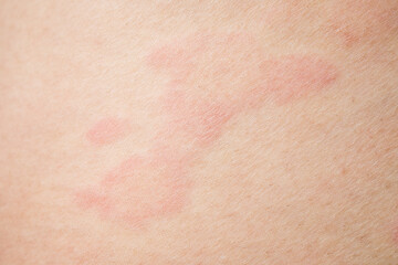 Fototapeta premium Skin allergy rash dermatitis texture close up background
