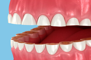 Dental attrition (Bruxism) resulting in loss of tooth tissue. Dental 3D illustration