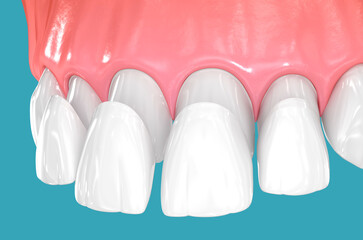 Dental veneers on blue background. 3D illustration