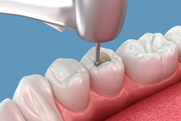 Making access to the root canal. Medically accurate tooth 3D illustration.