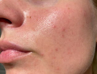Macro shot of a woman's cheek with visible pores, skin texture, acne marks and oil shine. Ideal for skincare, dermatology, facial treatment, beauty concepts. Natural and unretouched.