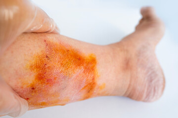 Fototapeta premium female leg with red jellyfish stings. Painful marine encounter. Beach safety awareness. Medical emergency on vacation. Ocean hazards, Vacation interrupted, stinging cells