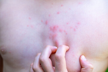 Preteen Child boy with red insect bug bites and rash on skin, scratching irritated skin, expressing mild pain, dermatology, rash treatment, allergic reaction, healthcare problem