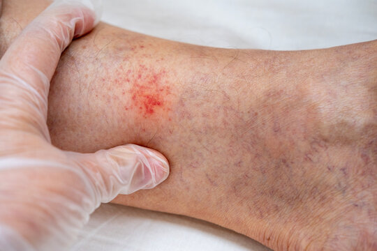 Capillary bleeding and petechiae caused by varicose veins on elderly patient&rsquo;s leg, Vascular pathology, small hemorrhages, red spots and vessel damage, Doctor touches irritated skin area