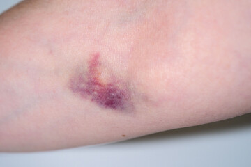 Naklejka premium bruise on female hand skin, hematoma on elbow area from blood draw, hurt mark, medical treatment, symptom medical condition, body pain, Health care