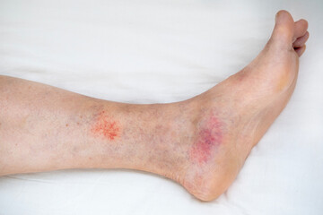Capillary bleeding and petechiae caused by varicose veins on elderly patient’s leg, Vascular pathology, small hemorrhages, red spots and vessel damage, Doctor touches irritated skin area