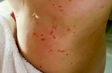 Fototapeta premium Sun-kissed skin displays celestial constellations of irritated blemishes, hinting at hidden tales of Holi skin transformations and spa escapades