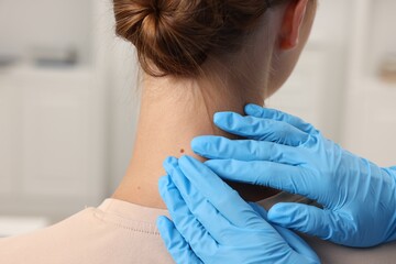 Doctor examining young woman's mole in hospital, closeup