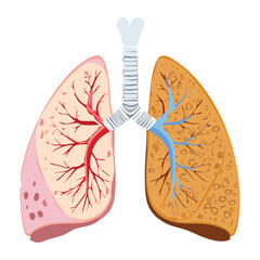 Human lungs anatomy with one lung showing a localized infection or respiratory illness