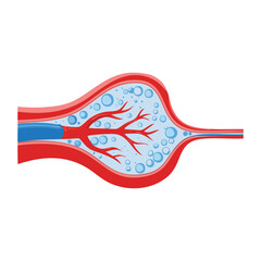Blood Vessel with Plaque and Cholesterol Narrowing the Artery