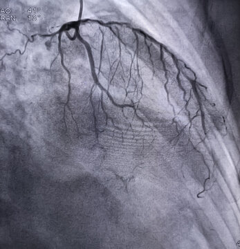 Coronary angiogram of left coronary artery during cardiac catheterization with contrast dye. Findings LAD are blocked. Colour adjust.