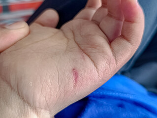 Obraz premium Hand with Small Injury Close Up View, First Aid Awareness