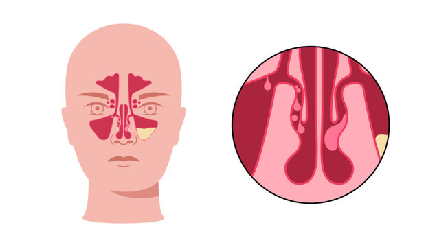 Nasal polyps poster