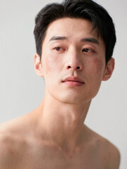 Fototapeta premium Young man with acne scars and facial redness