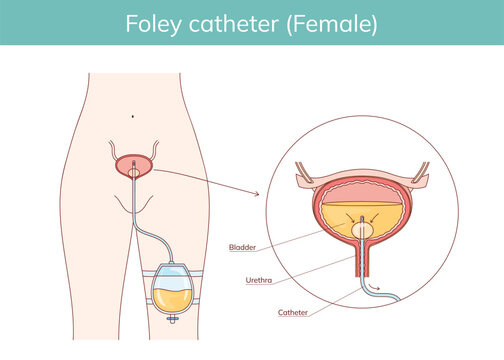Hand drawn diagram of structure of urinary foley catheter for women. Vector Medical scientific educational illustration.
