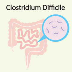 Flat vector illustration of Clostridium difficile with key symptoms like diarrhea, fever, abdominal pain, and similar diseases such as colitis and food poisoning.