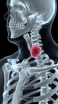 Detailed Thyroid Gland Anatomy with Red Highlight on Black Background Gray Skeletal Structure Visible for Medical Educational Purposes