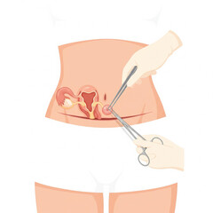 flat icon Ovarian cyst removal surgery, flat clean isometric ilustration