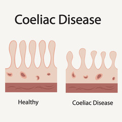 Flat vector illustration of coeliac disease showing key symptoms like bloating, diarrhea, fatigue, and highlighting related conditions such as IBS and Crohn’s disease.