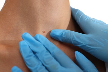 Doctor examining young woman's mole on white background, closeup