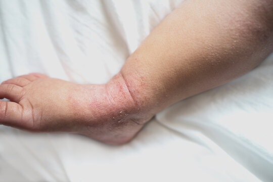 itchy dermatitis atopic baby foot and leg