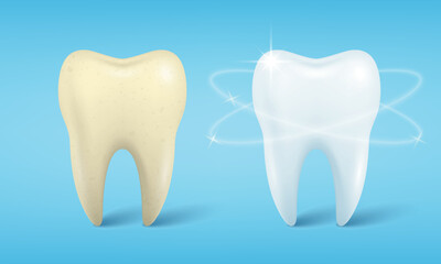 Vector Banner with Realistic Dirty and Clean Tooth. Cleaning Concept, Before, After Hygienic Teeth Cleaning. Dentistry Design for Medical, Toothpaste Advertisement. Healthy Oral Hygiene, Teeth Care