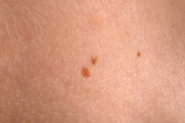 Woman with moles on her body, closeup
