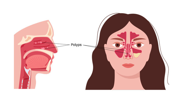 Nasal polyps poster