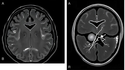 MRI of brain and MRA. CT Angiogram Brain showing anterior communicatting artery small dilatation, saccular aneurism. Hypoplasia of A1 segment. Cerebral atrophy.