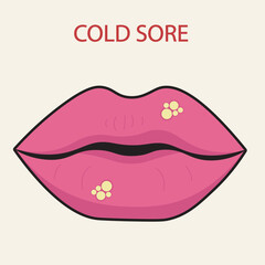 Cold sore vector illustration showing lip blisters, redness, and swelling. Includes symptoms like pain, itching, fever, and highlights similarity to canker sores and impetigo.