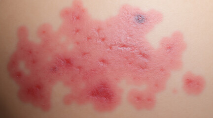 Fototapeta premium Dermatitis concept ,Patchy redness with cracked epidermis shows skin irritation and inflammation, indicating possible